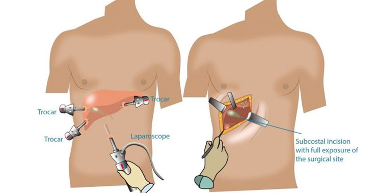 (ICG) Guided Surgery