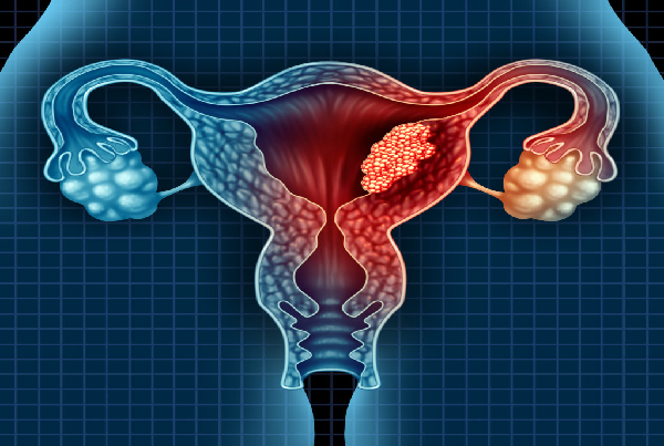 Best Gynecologic Cancer Surgeon
